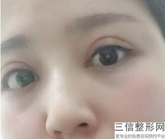广州双眼皮专家排名前八！ 陈伯华医生位列前十