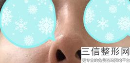 国内隆鼻整形医院排名前六！承德医学院附属医院整形科锁定前十