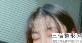 哈尔滨双眼皮医生排名前八总结！李开征医生实力非凡