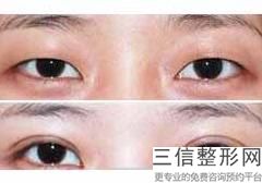 杭州激光近视眼哪家好!杭州西湖朝聚眼科医院实力入围