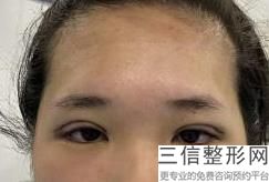 合肥割双眼皮整形医院排名前十！ 合肥智善美医疗美容医院实力上榜