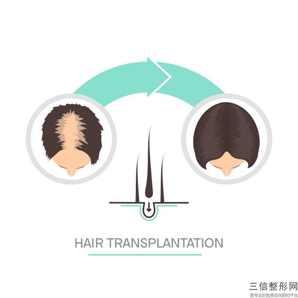 合肥植发医院排名前八！合肥碧莲盛植发实力非凡