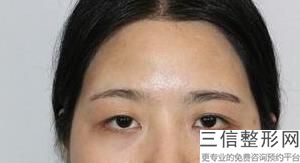 河南整形医院排名榜前十评点！郑州美眼整形医院口碑良好
