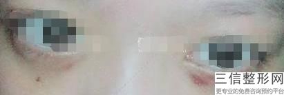 济南双眼皮手术哪家医院好！济南海峡美容整形医院实力非凡
