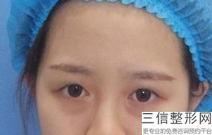 昆明铜雀台双眼皮医生排名前八！王杰医生不容错过