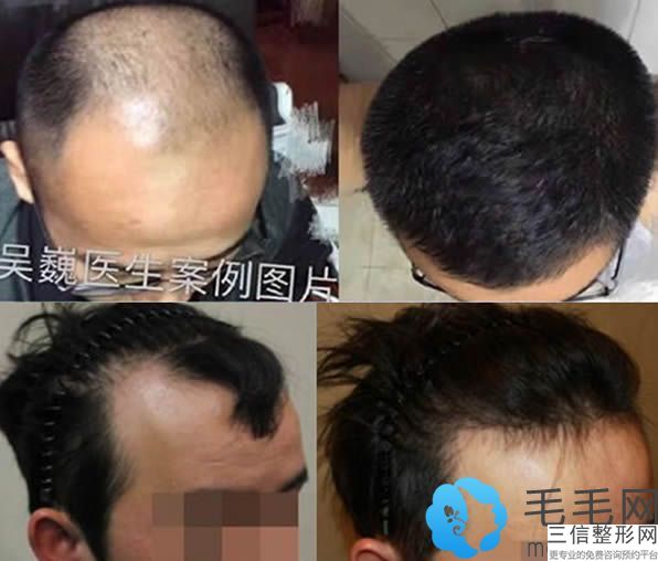 昆山植发医院排名前七！实力超强
