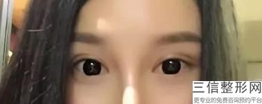 临汾双眼皮医生排名前十选前九！高一娜实力超强