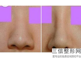 南京排名前10名隆鼻医生！姚刚医生实力上榜