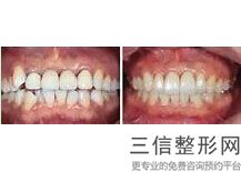 南京市种植牙医院排名榜！遥遥领先