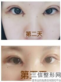 宁波割双眼皮哪个医生好！杨娴娴医生不容错过