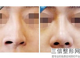 陕西隆鼻整形医院排名榜前五！宝鸡韩美医疗美容门诊部遥遥领先