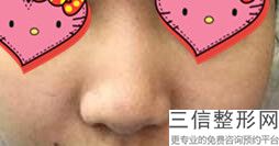 陕西隆鼻整形医院排名榜前五！宝鸡韩美医疗美容门诊部遥遥领先