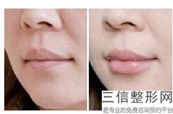 上海唇部整形医院排名前十！上海伊莱美医疗美容医院不容错过