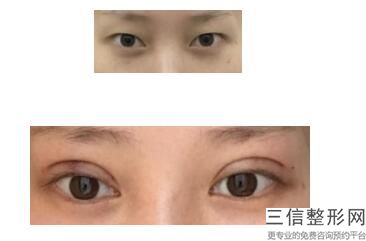 上海去眼袋整形医院排名前十！上海华美医疗美容医院不容错过