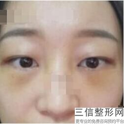 上海双眼皮医生排名前十！明慧医生实力上榜