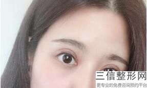 上海双眼皮医生排名前十！明慧医生实力上榜