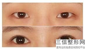 上海双眼皮整形医院排名前十,上海丽质医疗美容门诊部口碑不错