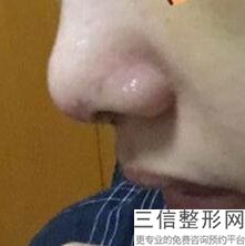 深圳隆鼻医院排行前十！深圳北大医院整形科排名靠前