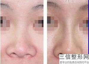 深圳隆鼻医院排行前十！深圳北大医院整形科排名靠前