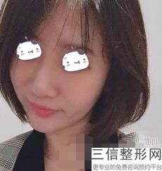 天津隆鼻医生推荐排名前八！刘容嘉医生排名靠前