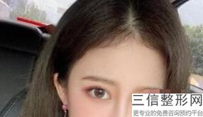无锡双眼皮整形医院哪家好！口碑良好