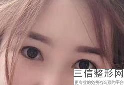无锡双眼皮整形医院哪家好！口碑良好