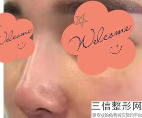 西安膨体隆鼻医院排行榜前五！西安美人鱼医疗美容机构不容错过