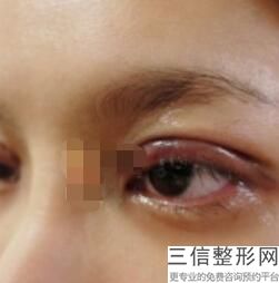 西安双眼皮医院排名前十！西安瑞美佳人医疗美容门诊部位列前十