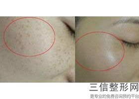 西安做拉皮手术医院排名前十！西安高一生医疗整形美容医院不容错过