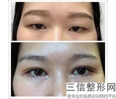 延吉双眼皮整形医院排名榜前五公布！延边大学附属医院整形烧伤科锁定前十