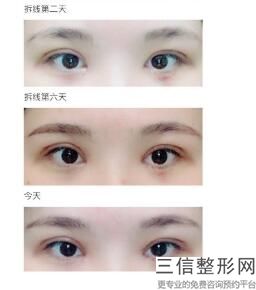 延吉双眼皮整形医院排名榜前五公布！延边大学附属医院整形烧伤科锁定前十