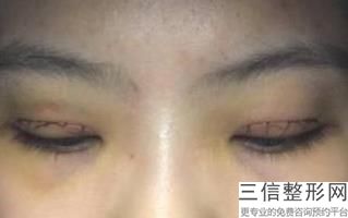 盐城割双眼皮哪家好!不容错过