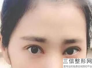 浙江双眼皮手术哪个医院好！ 浙江省中医院整形美容中心实力非凡