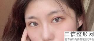 浙一医院双眼皮哪个医院好！浙一医院整形美容中心 李鹏飞排名靠前