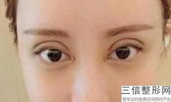 浙一医院双眼皮哪个医院好！浙一医院整形美容中心 李鹏飞排名靠前