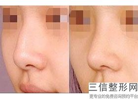 郑州隆鼻医院排名前十！郑州壹加壹美容整形机构遥遥领先