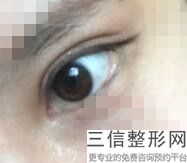 郑州眼部整形医生排名前六已出示！张栋益实力非凡