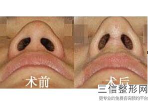 郑州做鼻综合整形医院排名前十! 郑州医大医院口碑不错