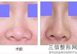 重庆隆鼻医生排名前十网友评选！李任口碑良好