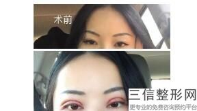重庆双眼皮整形医院排名榜前十名单曝光！重庆军科整形医疗美容医院不容错过