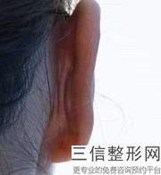 重庆自体耳软骨隆鼻医院排名前八！位列前十