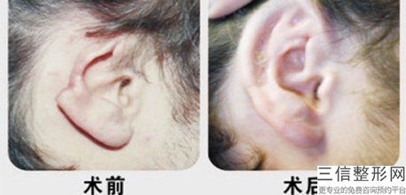 重庆自体耳软骨隆鼻医院排名前八！位列前十