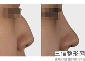 202国内硅胶假体隆鼻整形医院排名权威点评,硅胶假体隆鼻好医院