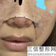 202国内硅胶假体隆鼻整形医院排名权威点评,硅胶假体隆鼻好医院