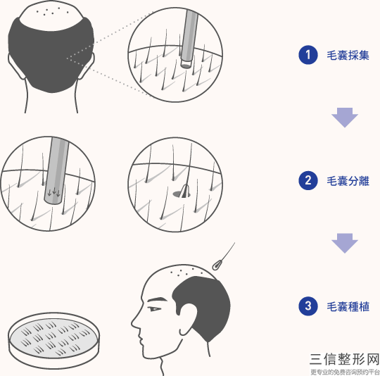 get一份乌鲁木齐植发医院排名榜前五强,新疆植发医院哪家医技术好