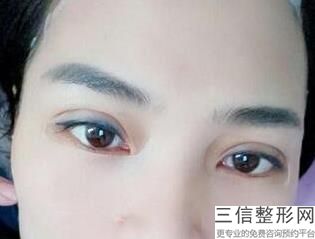 安徽做双眼皮整形专家前十名被曝光,安徽双眼皮手术