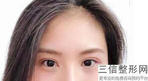 安徽做双眼皮整形专家前十名被曝光,安徽双眼皮手术