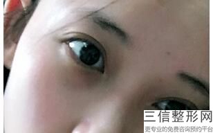 安徽做双眼皮整形专家前十名被曝光,安徽双眼皮手术