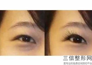 安徽做双眼皮整形专家前十名被曝光,安徽双眼皮手术