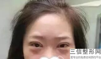 蚌埠开眼角美容整形医院排名榜前六明确了,蚌埠哪家医院割双眼皮好